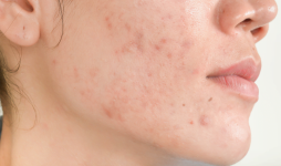 Dermatologist recommends a skincare regimen to address persistent acne
								